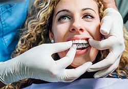 A dentist placing an Invisalign tray over a woman’s teeth
