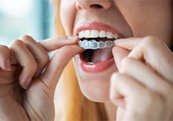 A woman placing an Invisalign tray over her teeth