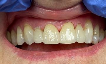 Flawless bright white smile after teeth whitening and porcelain veners