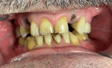 Smile with severe tooth decay and missing teeth