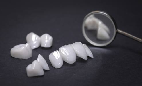 Porcelain veneers on tabletop prior to placement