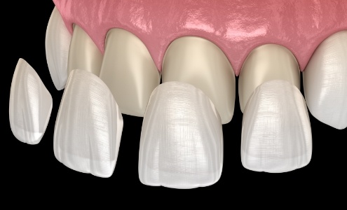 Smile during cosmetic dental bonding treatment