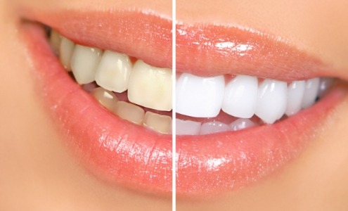 Smile before and after teeth whitening