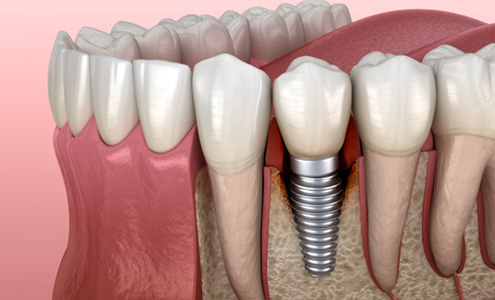 Illustration of bone loss around failed dental implant in Fort Mill, SC