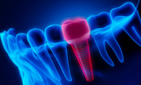 Illustration of lower jaw with dental implant highlighted in red