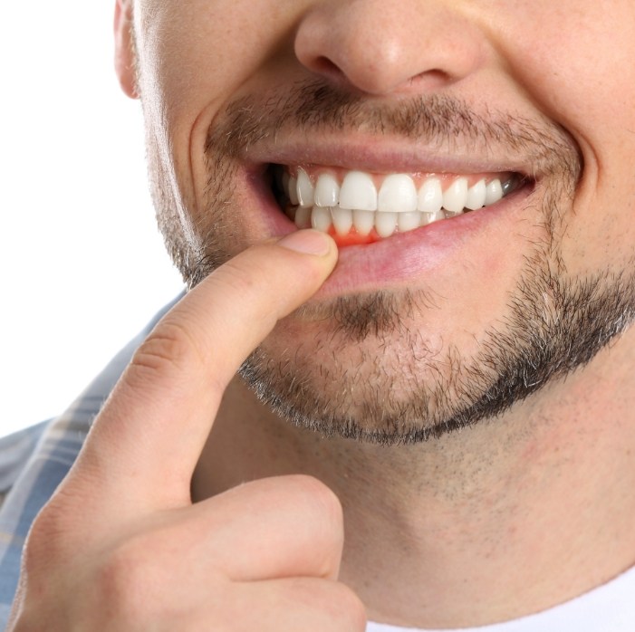 Closeup of smile with inflamed soft tissue in need of gum disease treatment