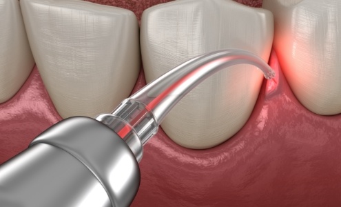 Animated smile during laser scaling and root planing