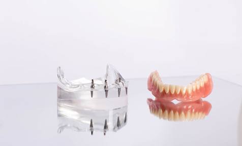 Implant denture next to model of jawbone