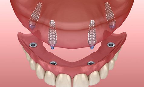 Illustration of implant denture for upper dental arch