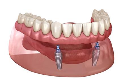 Illustration of removable ball-retained implant denture