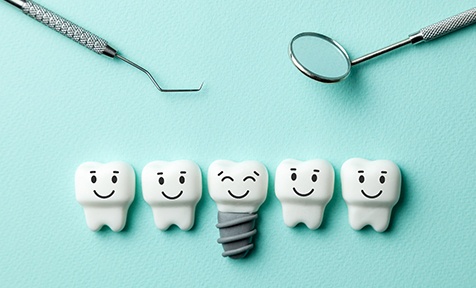 Illustration of dental implants