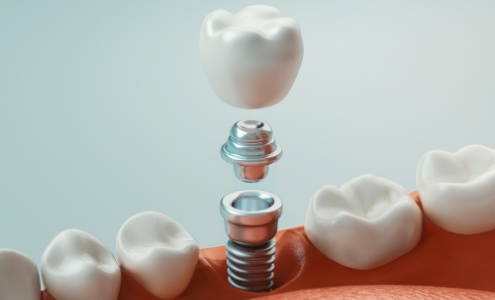 Animated smile representing the four step dental implant process