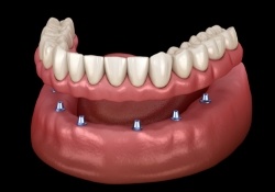 Animated smile during dental implant supported denture placement