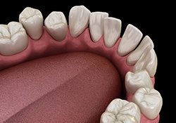 Illustration of gapped teeth