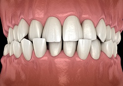 Illustration of crossbite