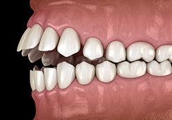 Illustration of openbite