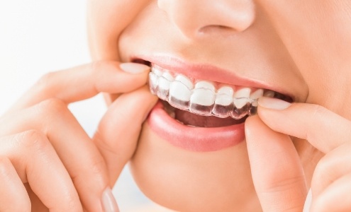 Closeup of patient placing an Invisalign tray