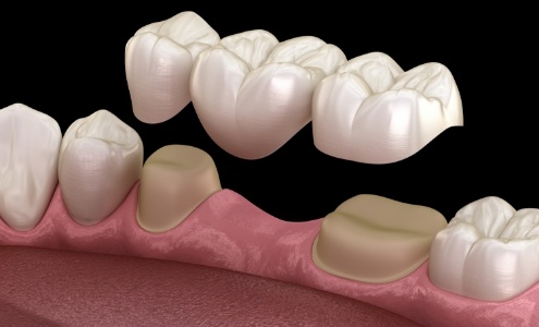 Animated smile during dental bridge placement