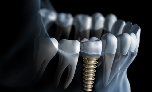 Animated smile with dental implant supported dental crown