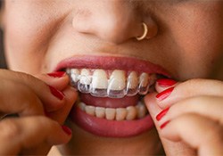 Person placing Invisalign aligner on her teeth