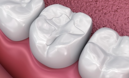 Animated smile with dental sealants