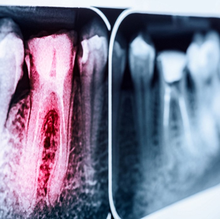 an X-ray representing root canal therapy in Fort Mill