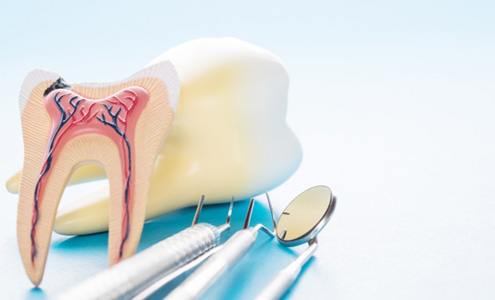 a model tooth representing root canal therapy in Fort Mill
