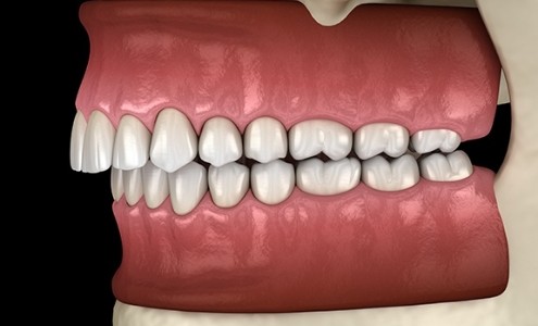 Animated jaw in need of occlusal adjustment