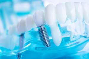 Close-up of dental implants in a clear plastic tray