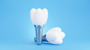 Two dental implants with one lying on its side